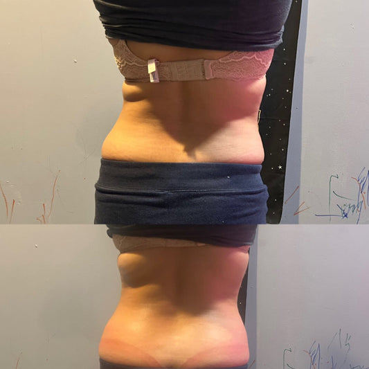 Cavitation 45 min Full Upper body(arms+ stomach+back) + Laser LIpo